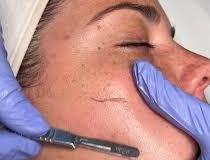 dermaplaning-4