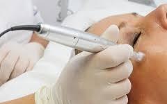 microneedling-2